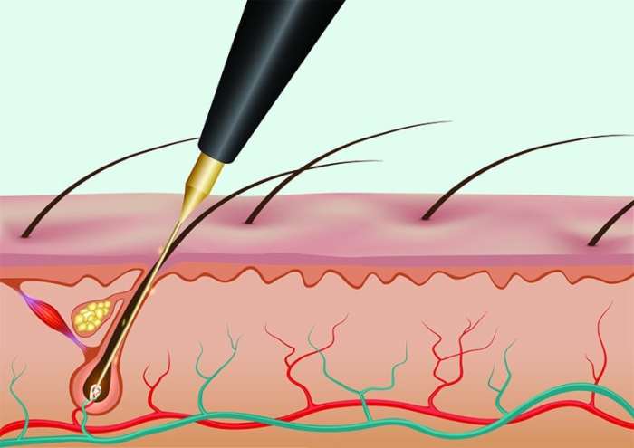 The thermolysis method of electrolysis is also called the: