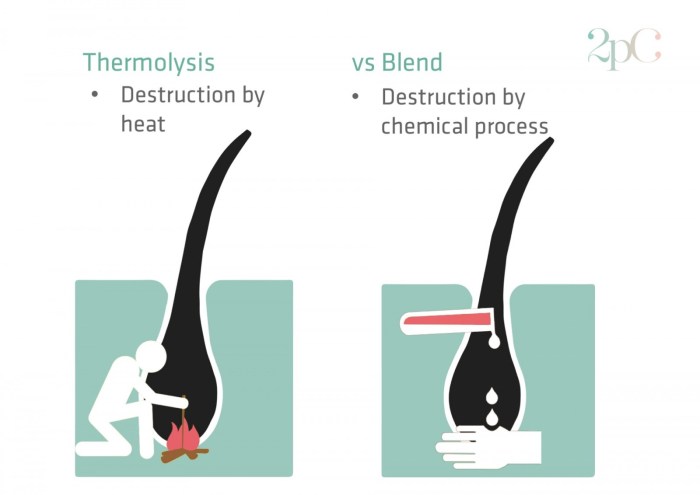 Thermolysis clinic removal 2pass alternating electrolysis